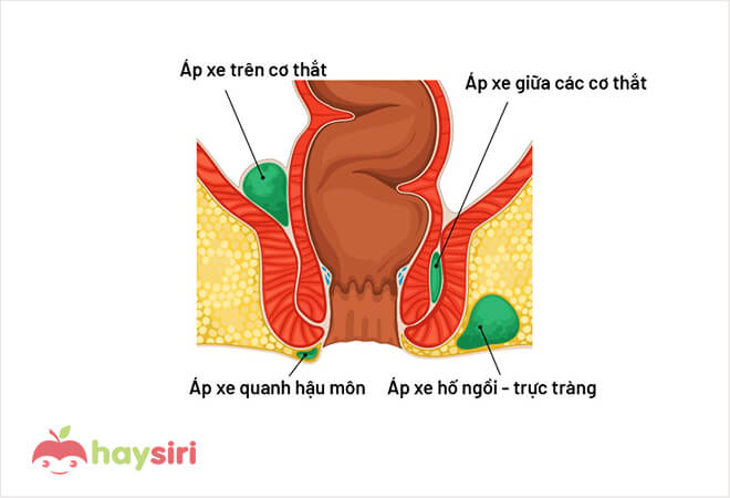 phân loại áp xe hậu môn