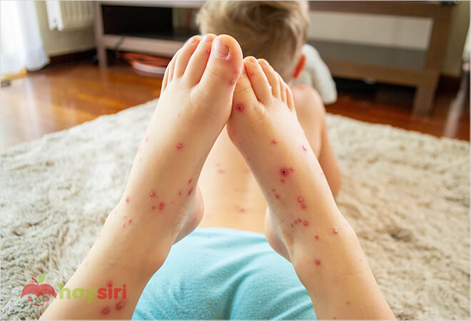 bệnh rubella có lây không