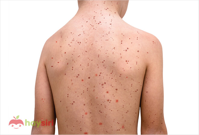 bệnh rubella là gì