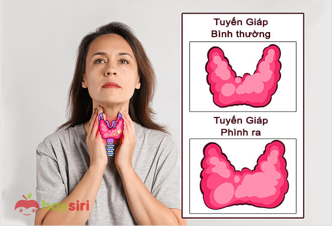 triệu chứng của bệnh basedow