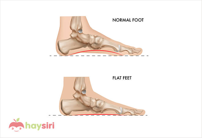 nguyên nhân gây bệnh bàn chân bẹt