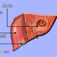 Áp xe gan là gì? Những biến chứng nguy hiểm của áp xe gan