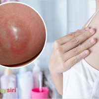 Bệnh Áp xe Vú - Nguyên nhân, triệu chứng, Cách điều trị và phòng ngừa