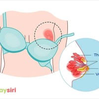 Tắc tia sữa bao lâu thì bị bệnh áp xe vú? Phòng tránh và xử lý hiệu quả