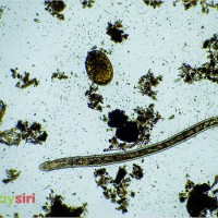 Bệnh ấu trùng sán lợn: Hiểm họa ẩn giấu trong cơ thể và cách ngăn chặn!