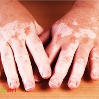 Bệnh bạch biến là gì? Dấu hiệu nhận biết và điều trị bệnh bạch biến