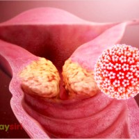 Bệnh Bạch sản cổ tử cung: Tìm hiểu căn bệnh gây ám ảnh của phụ nữ