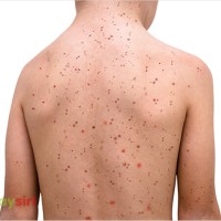 Bệnh Rubella là gì? Tìm hiểu về “đại dịch đỏ” và những nguy cơ tiềm ẩn