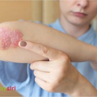 Bệnh vảy nến có lan rộng không? Một số biểu hiện giai đoạn đầu của bệnh vảy nến