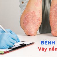 Bệnh vảy nến: khám phá về nguyên nhân, và cách điều trị tình trạng da khó chịu này