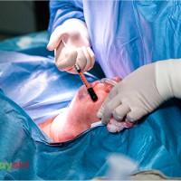 Bệnh Basedow: Liệu phẫu thuật có phải là lựa chọn tốt?