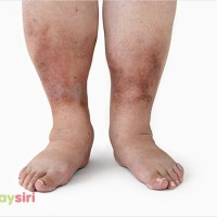Khám phá căn bệnh bàn chân bẹt ở người lớn và những phương pháp chữa trị tiên tiến