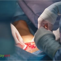 Bướu cổ lành tính có nên mổ không? Những rủi ro và lợi ích ảnh hưởng tới sức khỏe của bạn