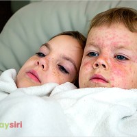 Bệnh Sởi: Hiểu rõ nguyên nhân, nhận biết triệu chứng và phương pháp điều trị hiệu quả