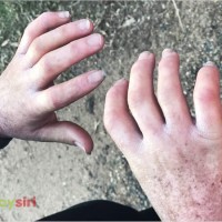 Xơ cứng bì có nguy hiểm không? Bệnh có chữa khỏi được không