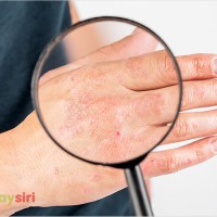 Bệnh xơ cứng bì toàn thể: Hiểu và đối diện với tình trạng khó khăn