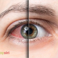 Hiểu rõ về bệnh đau mắt đỏ: Nguyên nhân, Triệu chứng và cách điều trị Hiệu Quả