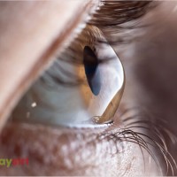 Bệnh giác mạc chóp là gì? Hiểu rõ nguyên nhân, triệu chứng và cách điều trị