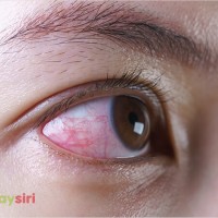 Đau mắt đỏ bao lâu thì khỏi? Chia sẻ mẹo chữa đau mắt đỏ nhanh nhất