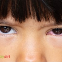 Cùng tìm hiểu về Đau Mắt Đỏ ở Trẻ Em: Nguyên nhân và cách điều trị nhanh khỏi bệnh