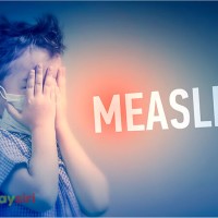 Lý do tại sao bạn có thể bị mắc bệnh sởi và những dấu hiệu cần lưu ý