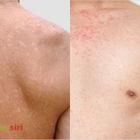 Lang ben trắng và lang ben đỏ: Sự khác biệt và cách chăm sóc điều trị