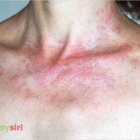 Dấu hiệu và nguyên nhân bất thường của bệnh lang ben: Bạn đã biết chưa?