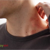 Các loại thuốc sử dụng trong điều trị bệnh Lang Ben