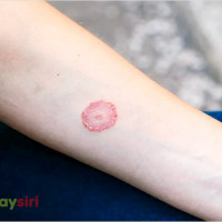 Bệnh chàm đồng tiền: nguyên nhân, biểu hiện và cách điều trị hiệu quả